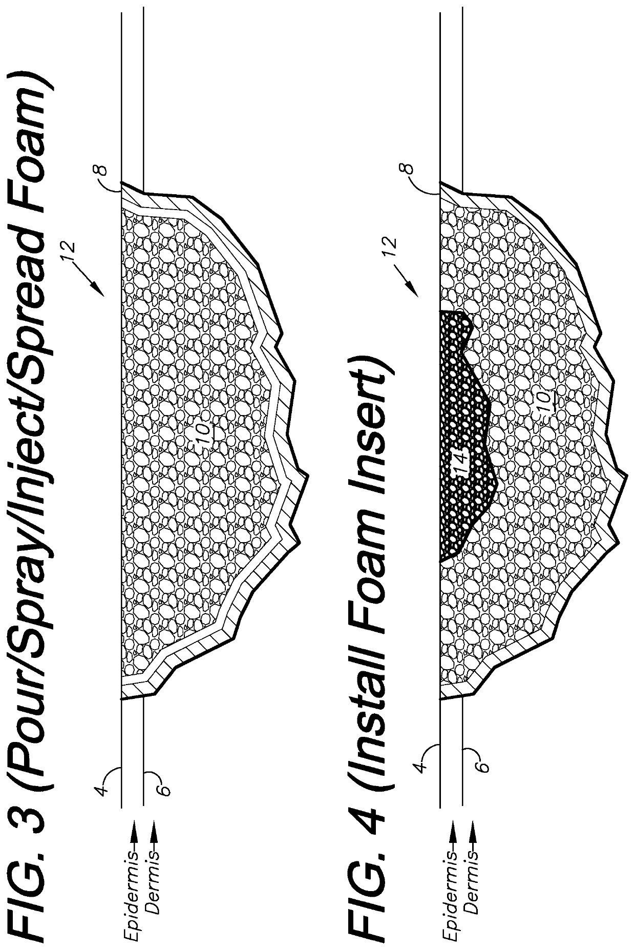 Wound treatment system and method