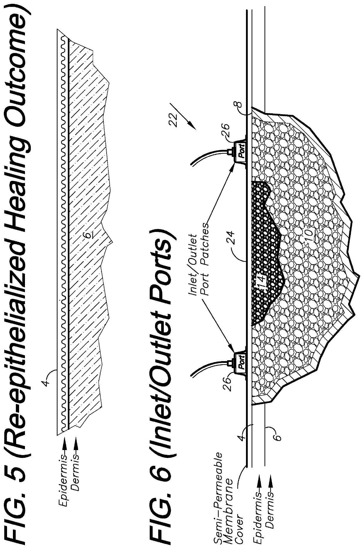 Wound treatment system and method