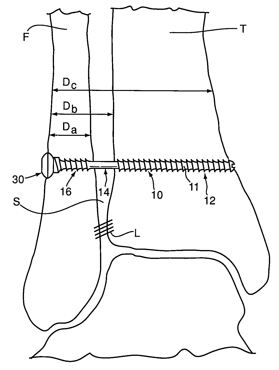 Bone fixation device and method of use thereof