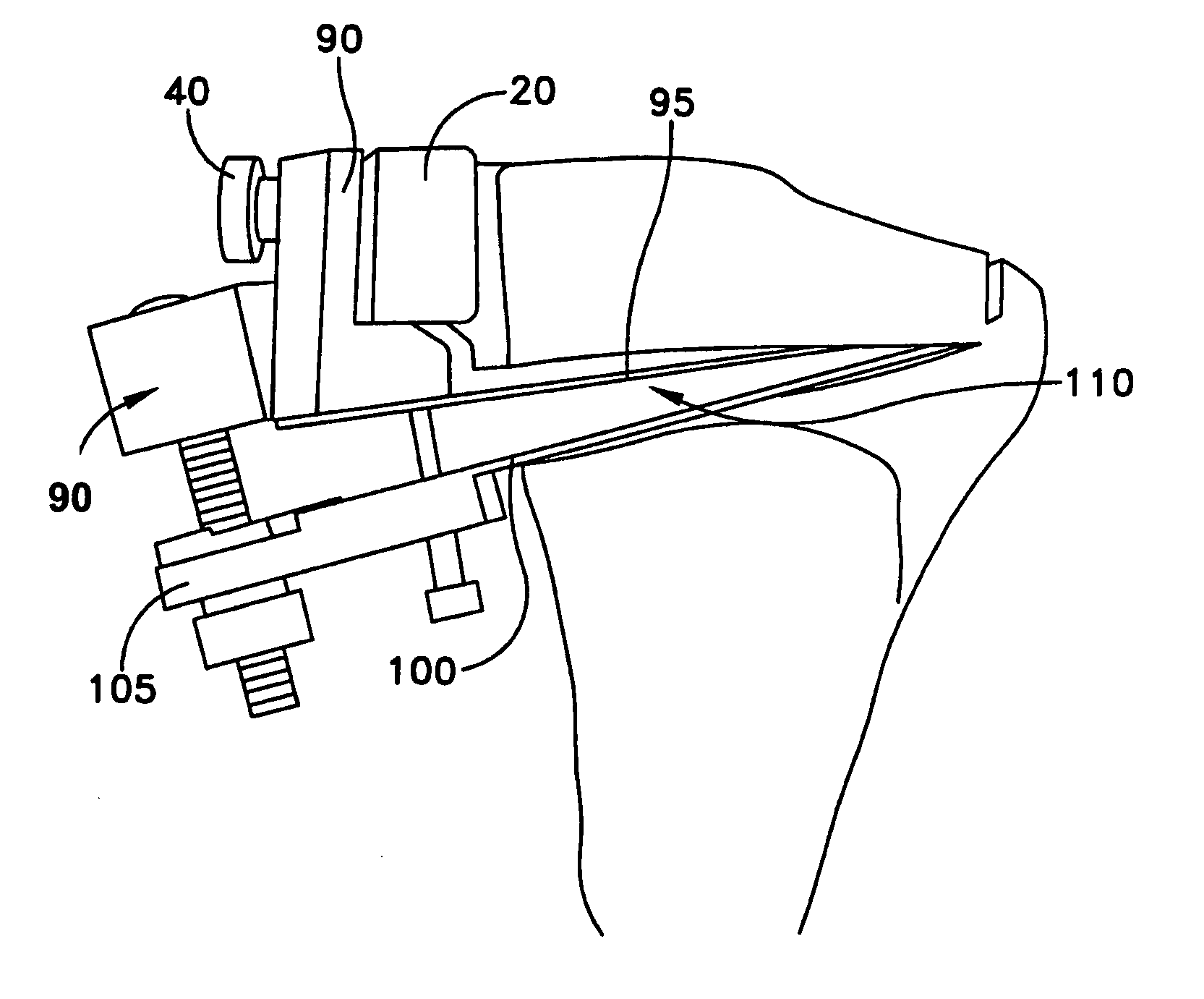 Open wedge osteotomy system and surgical method