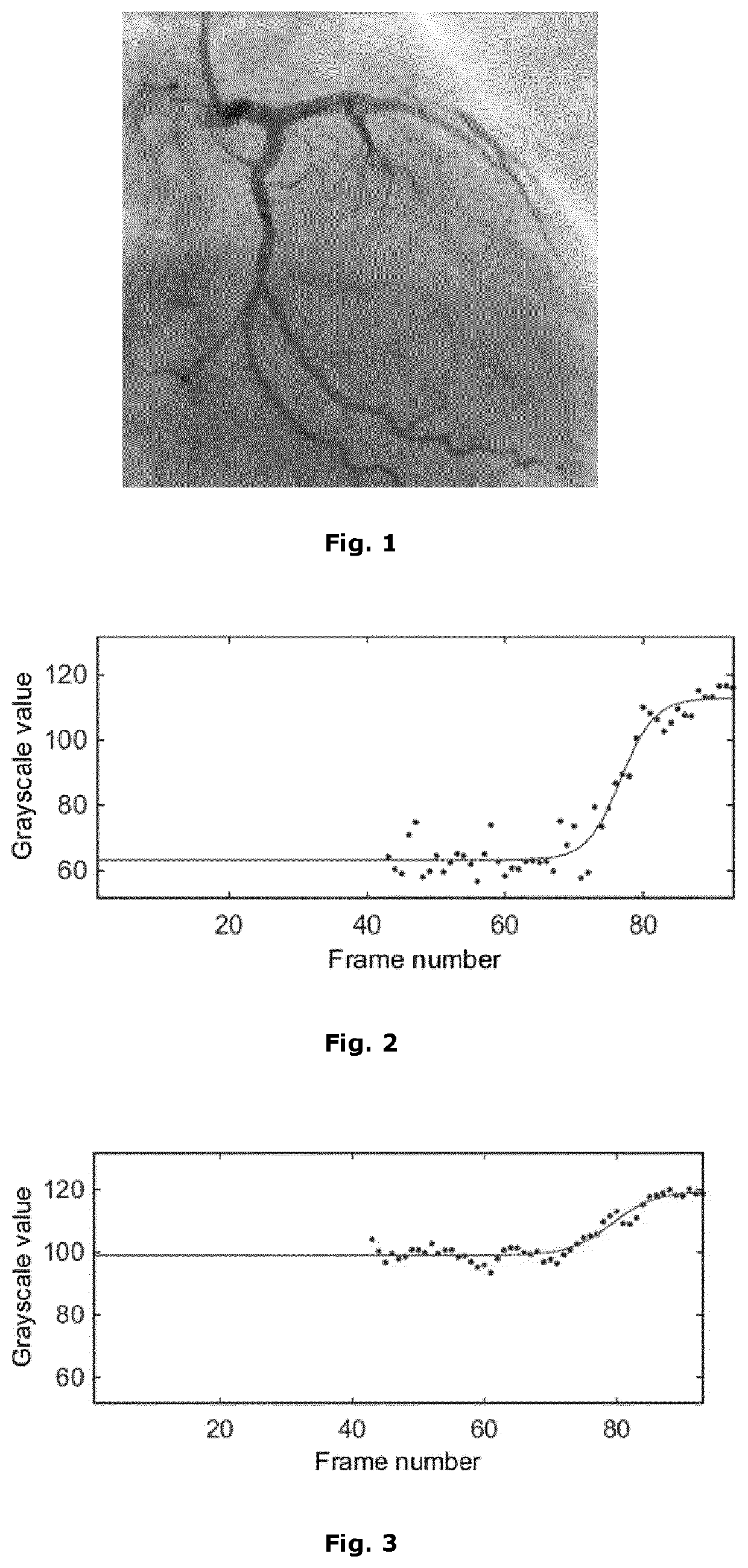 Computer-implemented method for identifying zones of stasis and stenosis in blood vessels