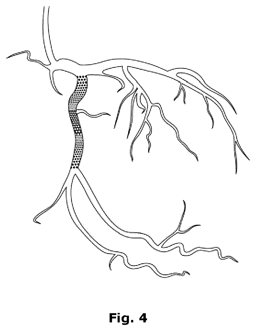 Computer-implemented method for identifying zones of stasis and stenosis in blood vessels