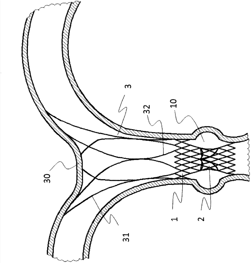 Pulmonary valve stents to prevent displacement