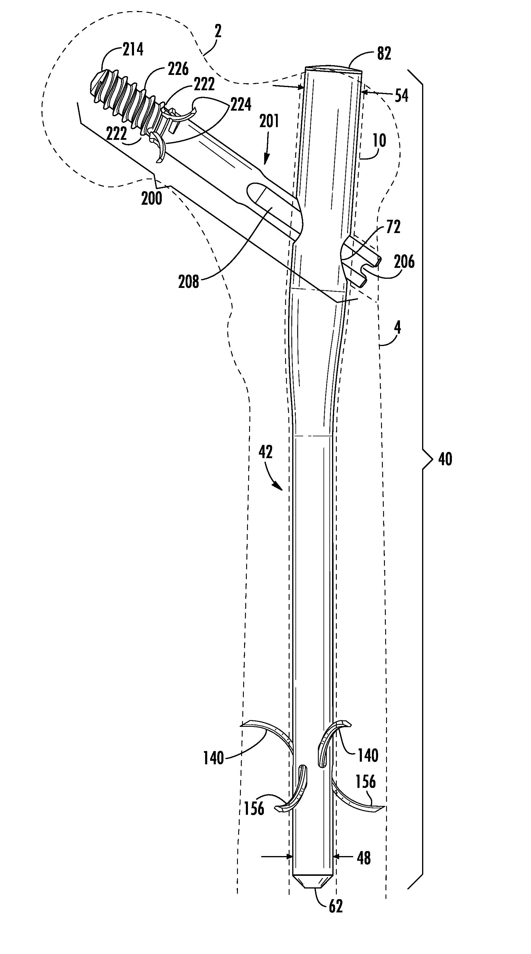 Intramedullary nail system including tang-deployment screw with male interface