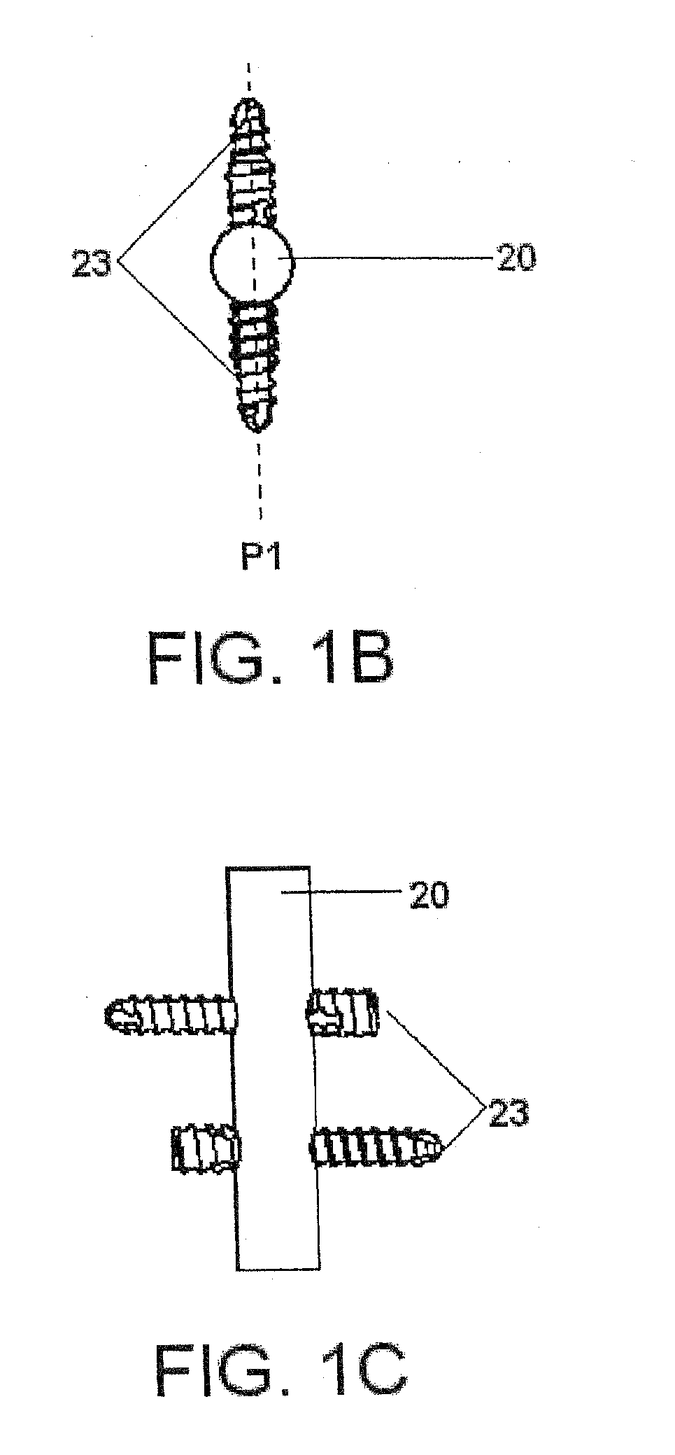 Nail System and Method for an Olecranon Osteotomy