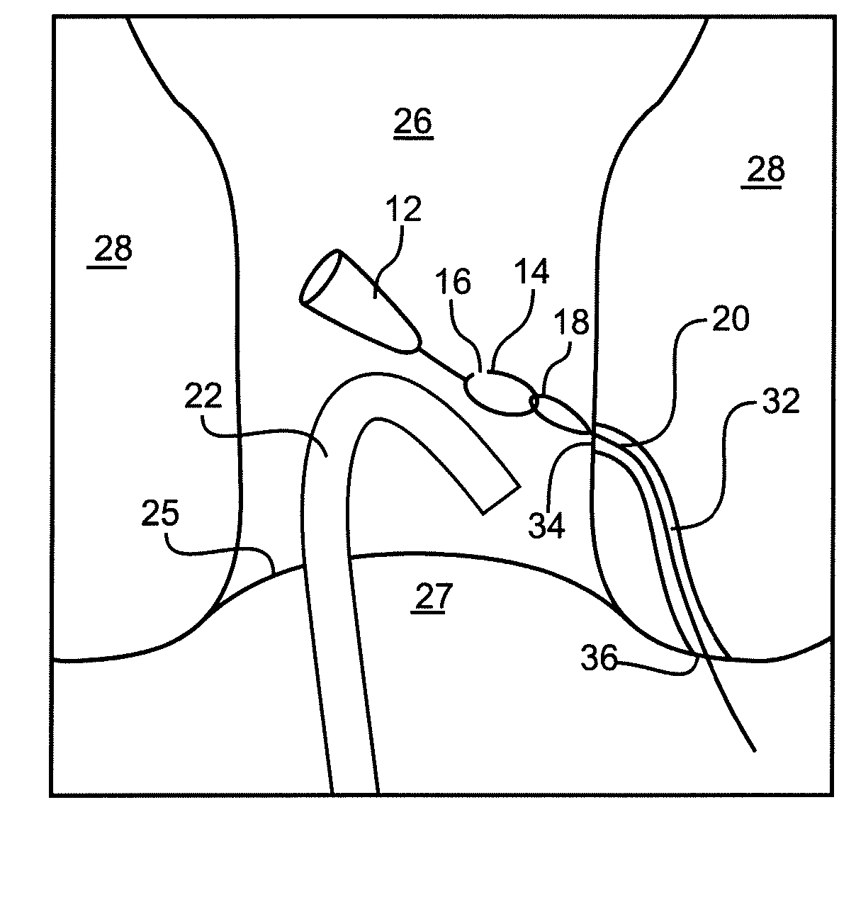Devices And Methods For Occluding A Fistula