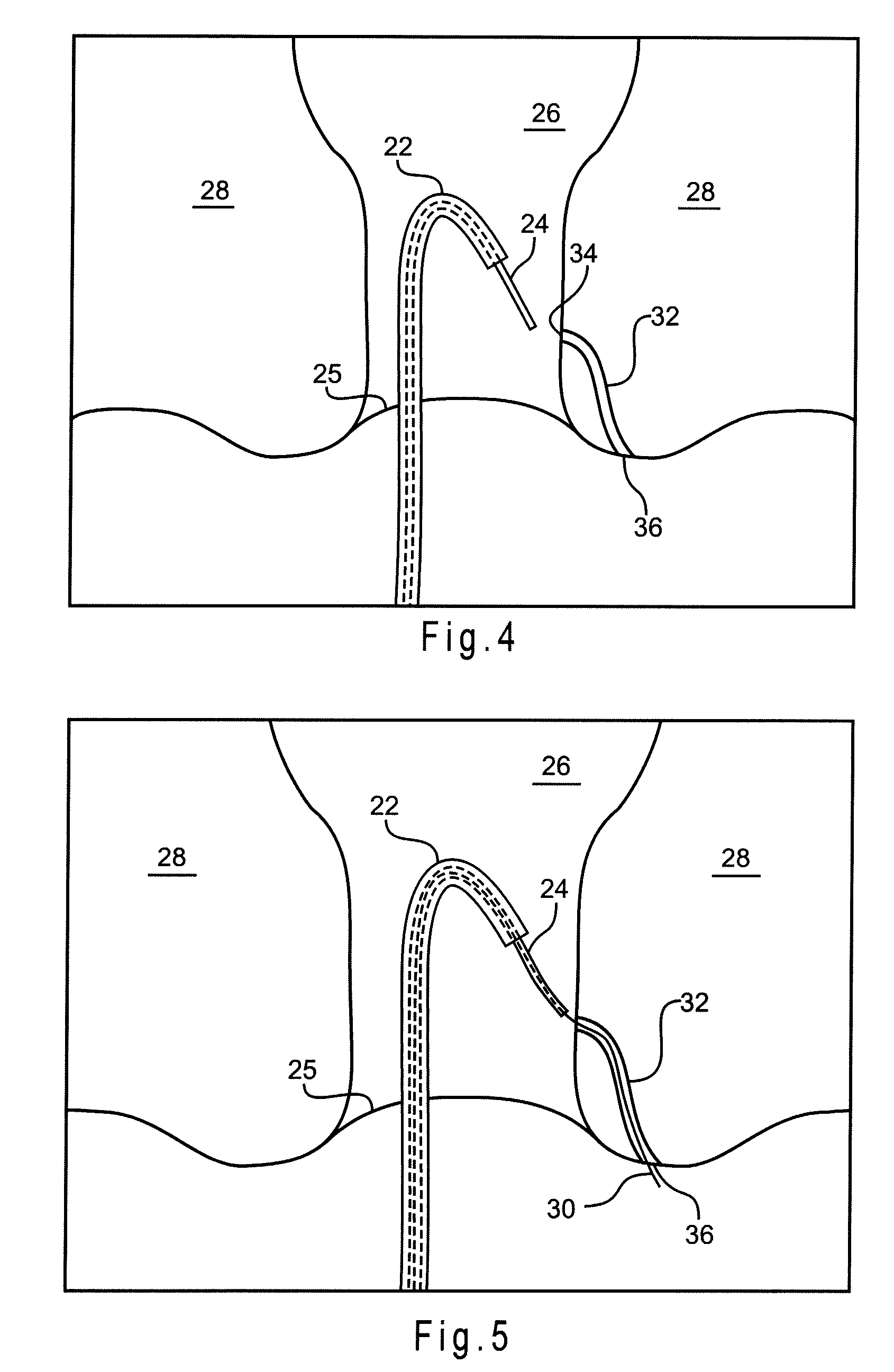 Devices And Methods For Occluding A Fistula