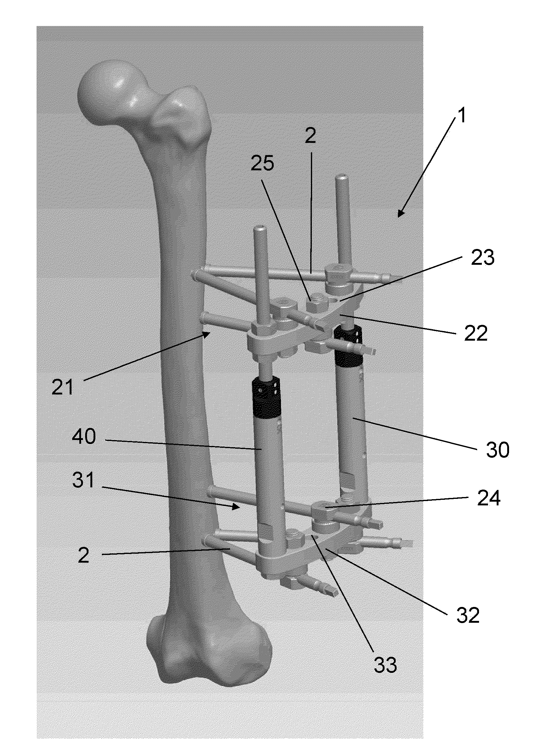 Method for Treating a Fracture of a Bone Having a Medullary Canal