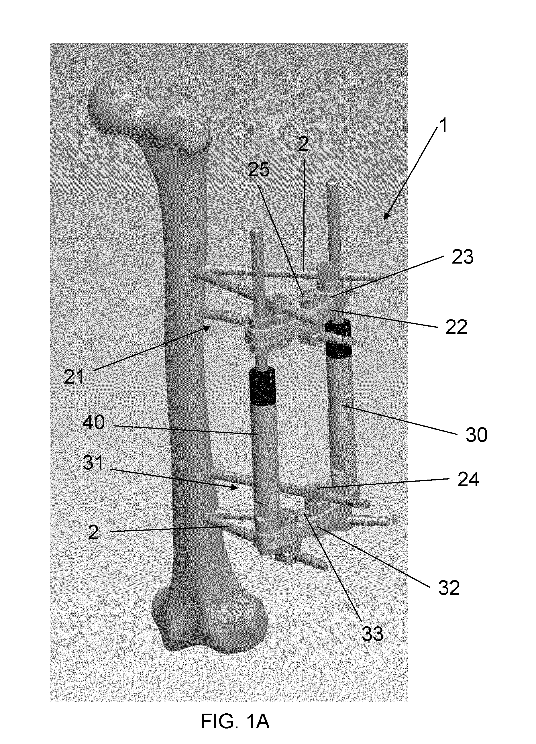 Method for Treating a Fracture of a Bone Having a Medullary Canal