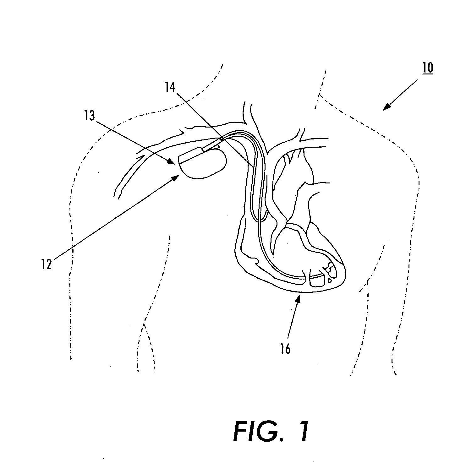 Medical device with an electrically conductive anti-antenna member