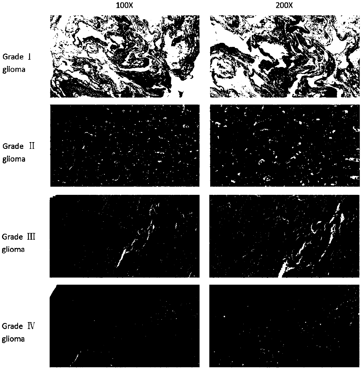 Application of RDH10 gene to brain glioma diseases