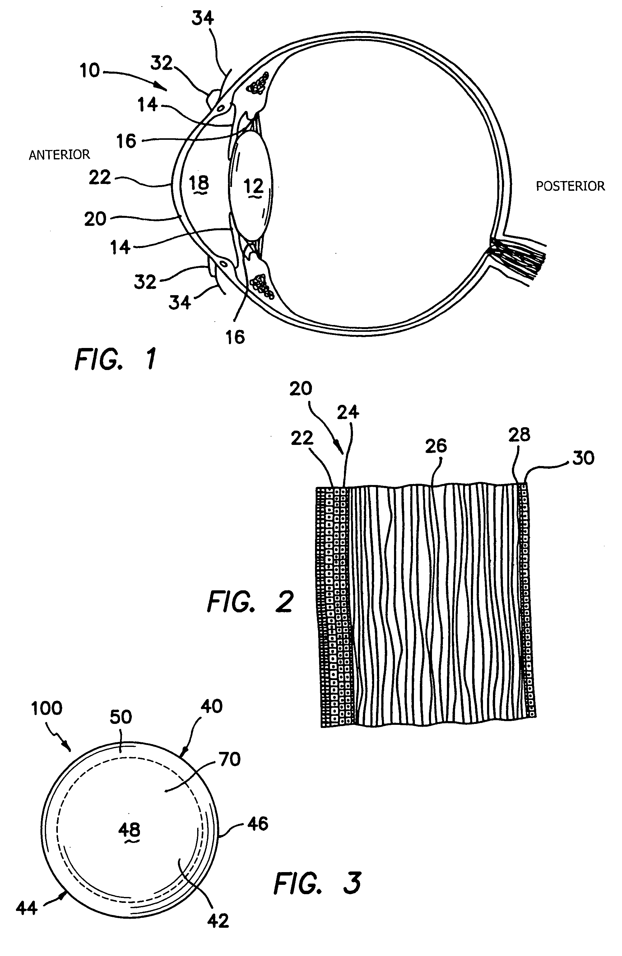 Intrastromal devices and methods for improving vision