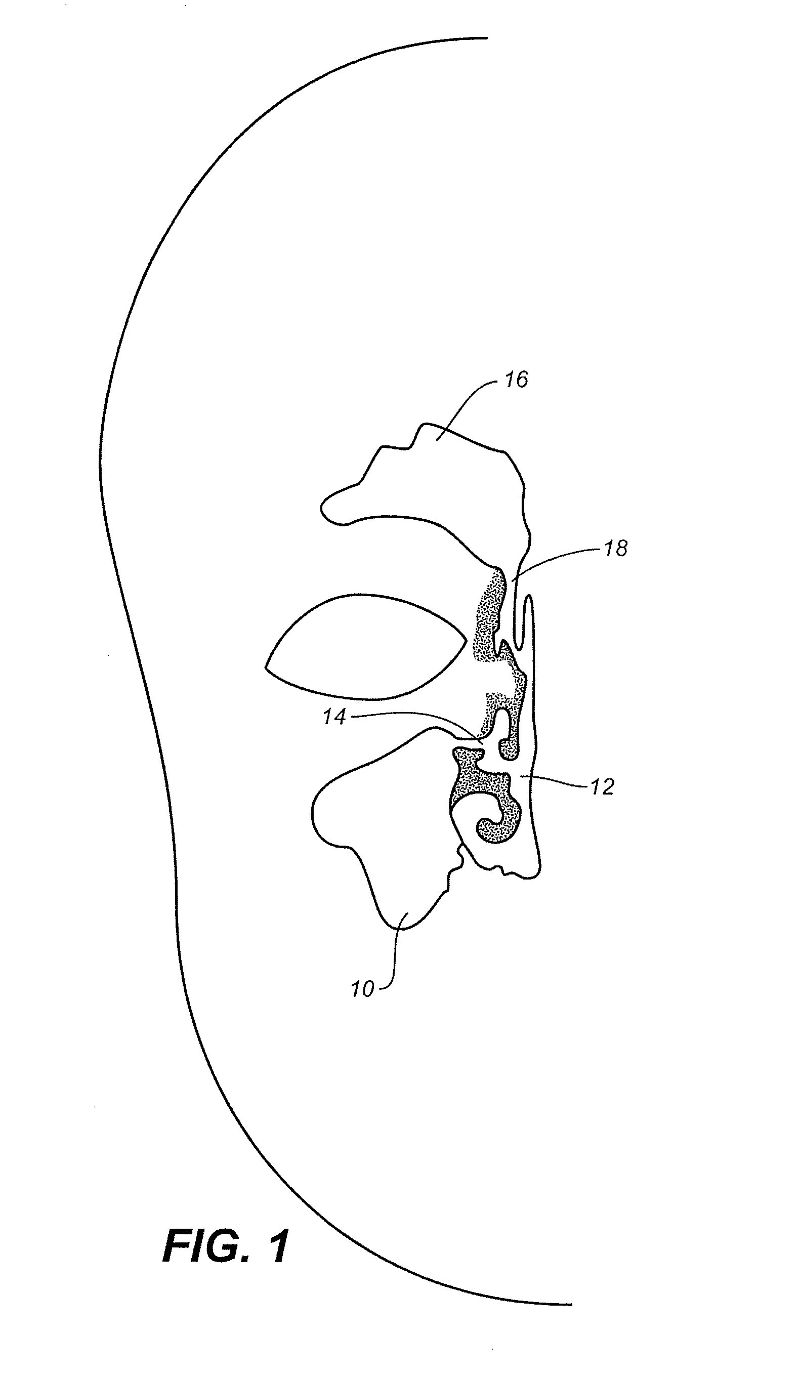 Device and methods for treating paranasal sinus conditions