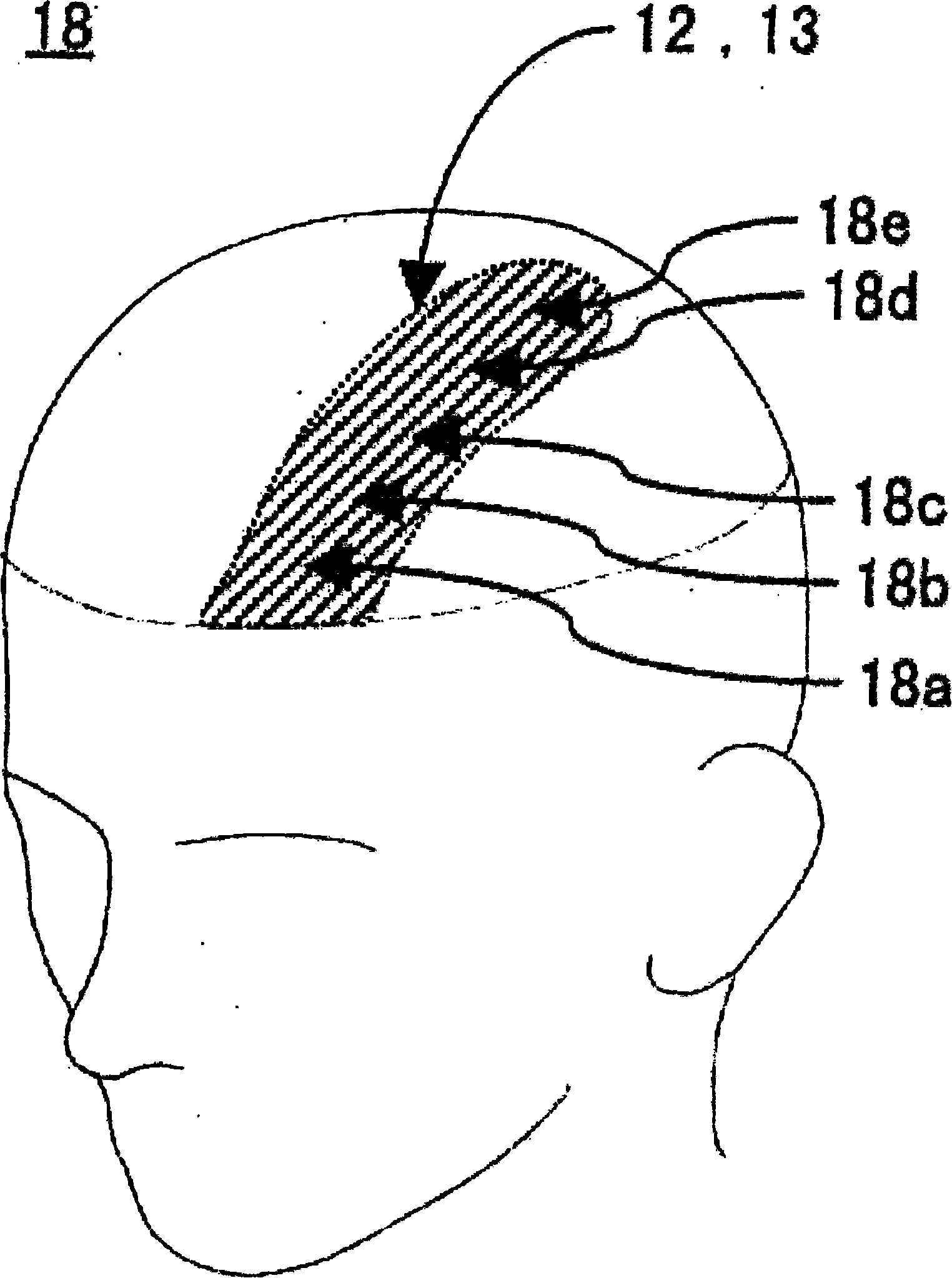 A artificial scalp surface layer non hair buckled hairpiece and its preparation method