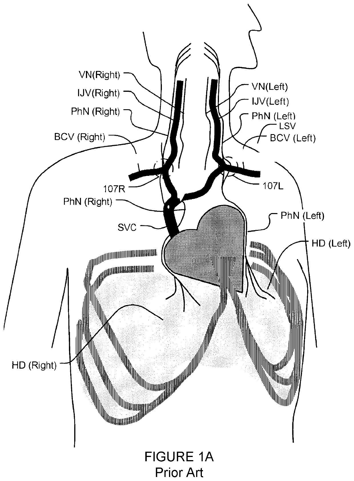 Transvascular nerve stimulation apparatus and methods