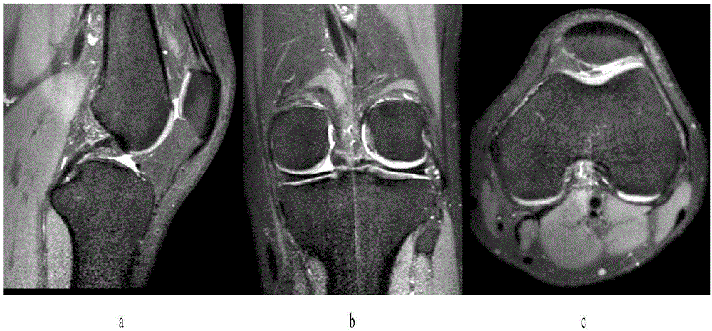 Method for establishing human knee joint three-dimensional simulation model in combination with CT (Computed Tomography) and MRI (Magnetic Resonance Imaging)