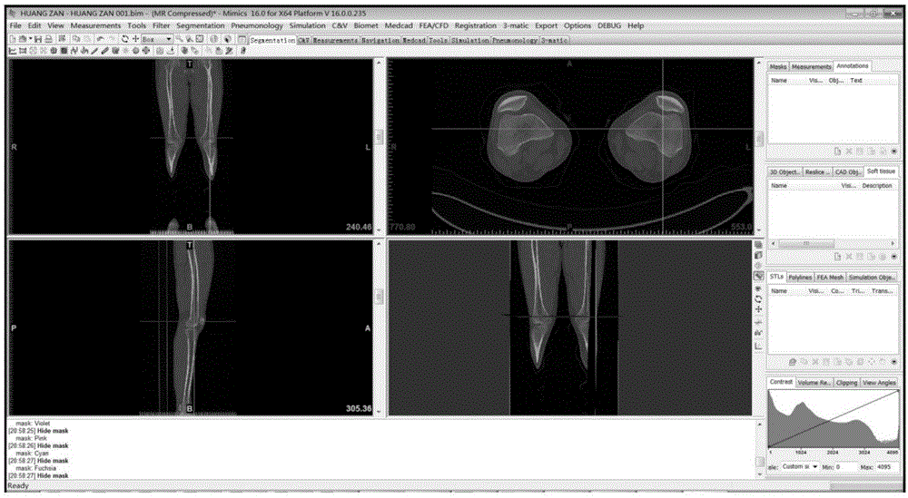Method for establishing human knee joint three-dimensional simulation model in combination with CT (Computed Tomography) and MRI (Magnetic Resonance Imaging)