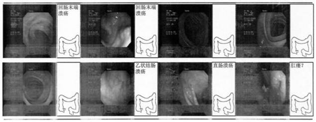 Traditional Chinese medicine composition for treating Crohn's disease and application thereof