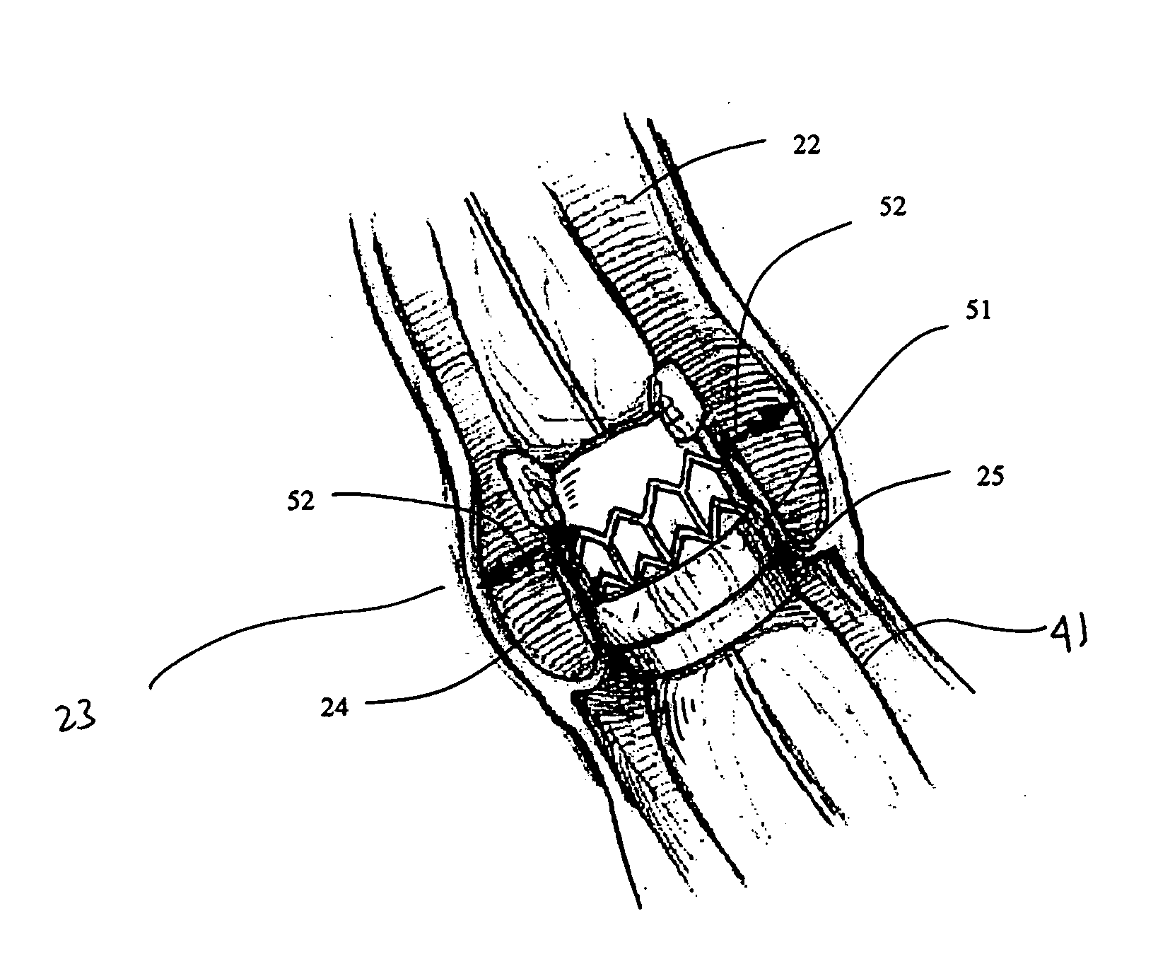Method and system for cardiac valve delivery
