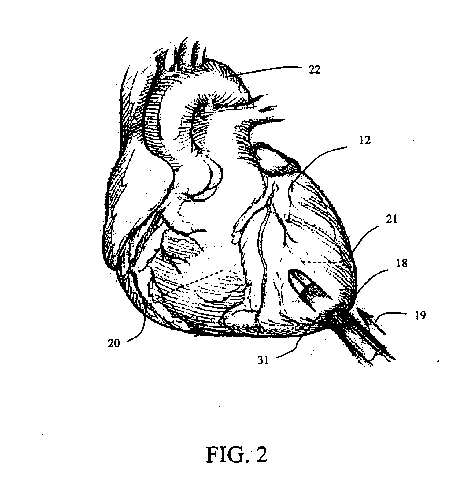 Method and system for cardiac valve delivery