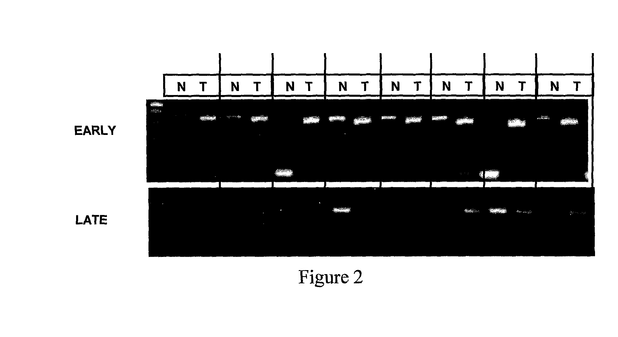 Tumor Specific Genes and Variant Rnas and Uses Thereof as Targets for Cancer Therapy and Diagnosis