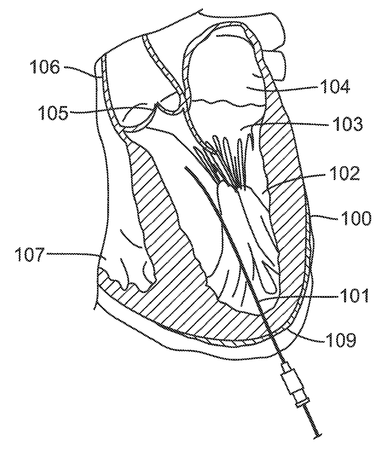 Percutaneous interventional cardiology system for treating valvular disease