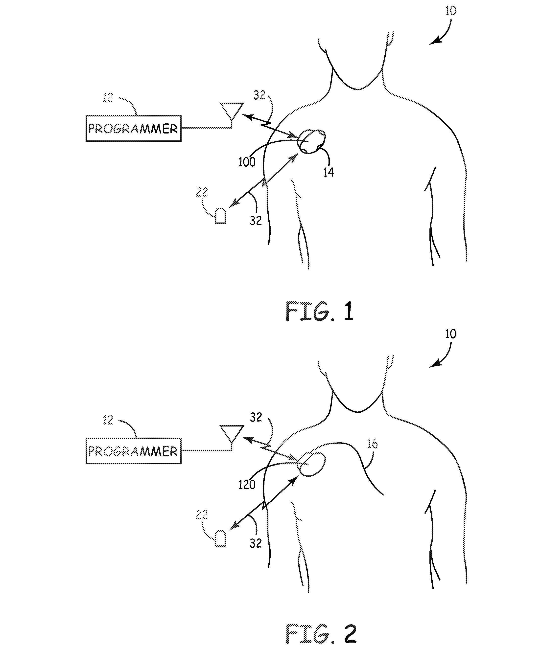 System and method for segmenting a cardiac signal based on brain activity