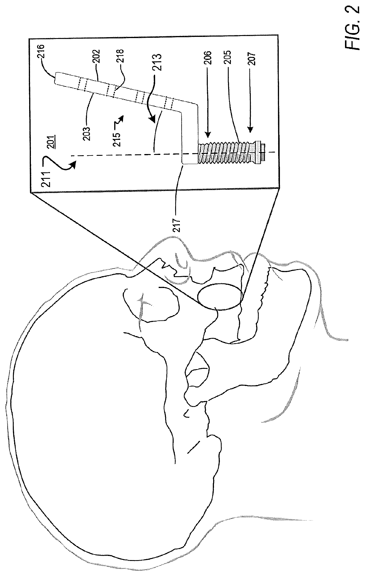 Apparatus and method for a transalveolar dental implant