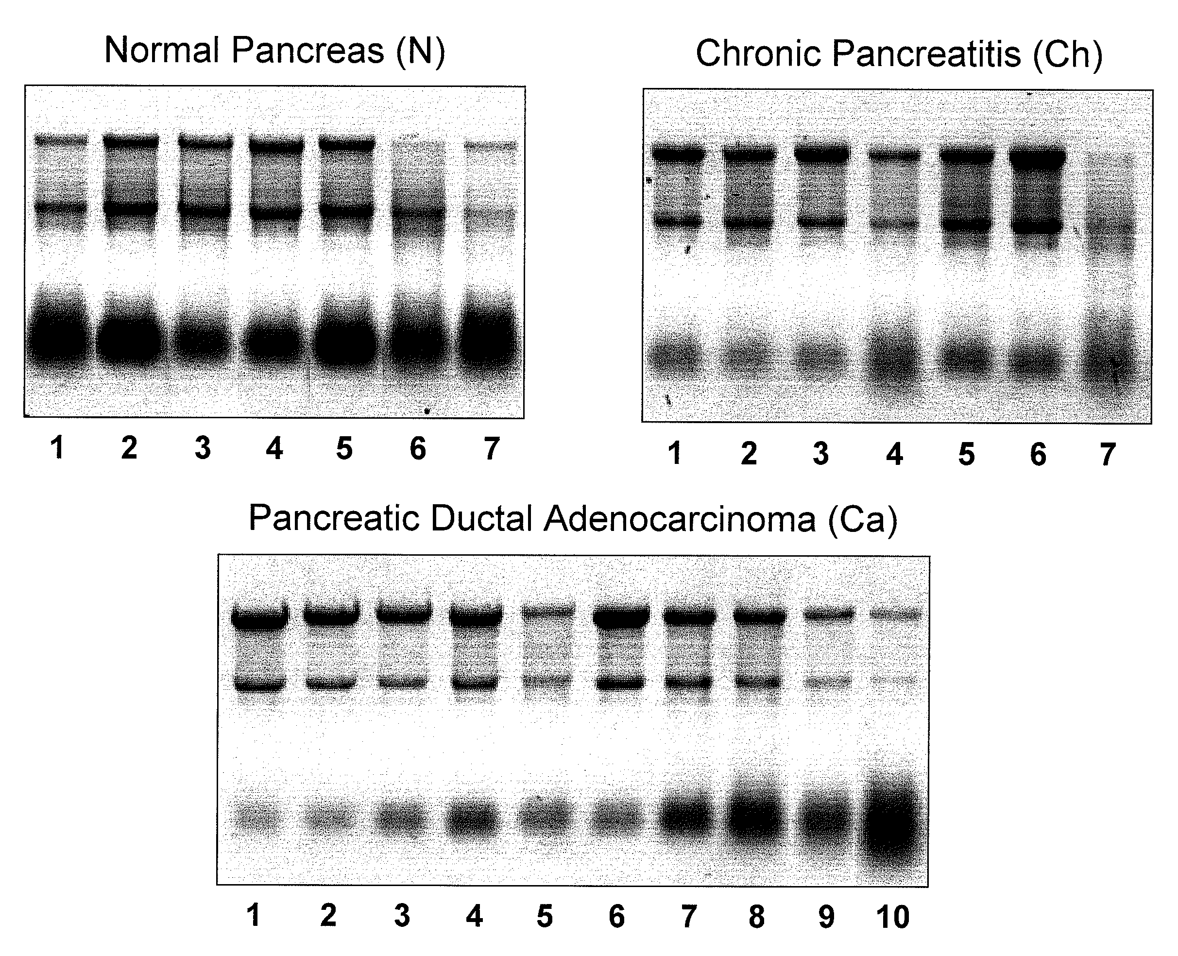 Micrornas differentially expressed in pancreatic diseases and uses thereof