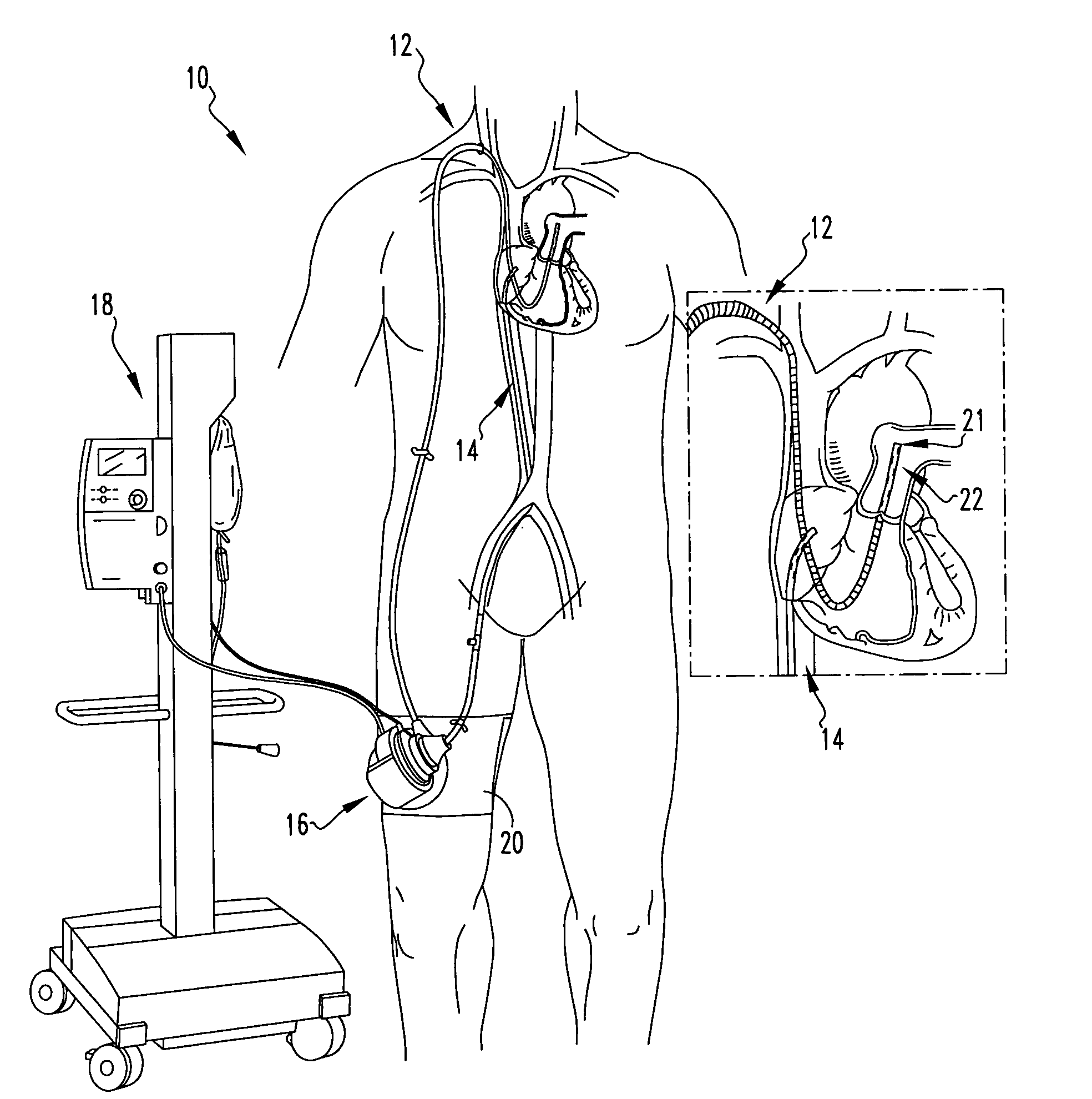 Percutaneous right ventricular assist apparatus and method