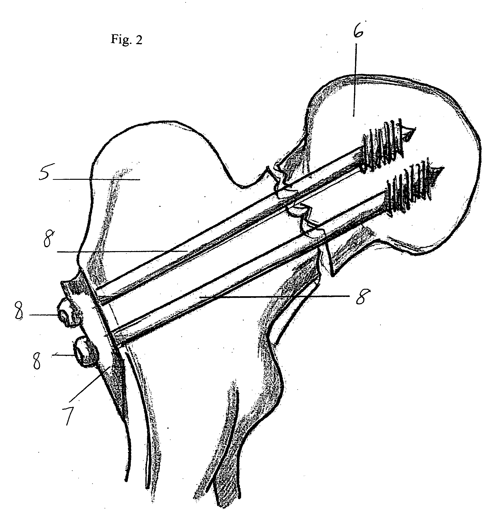 Bone plating system for treatment of hip fractures