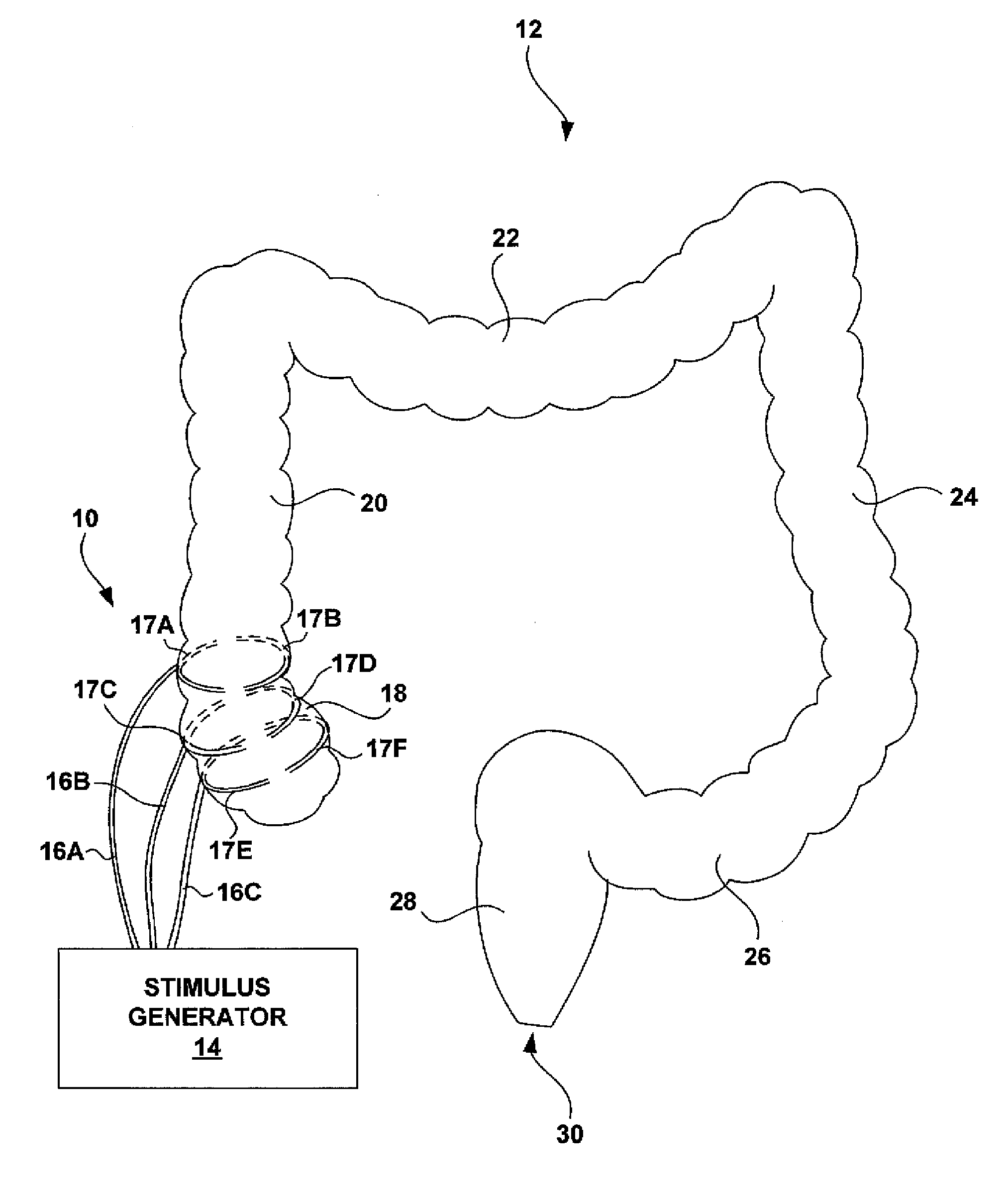 Electrical stimulation of the colon to treat chronic constipation