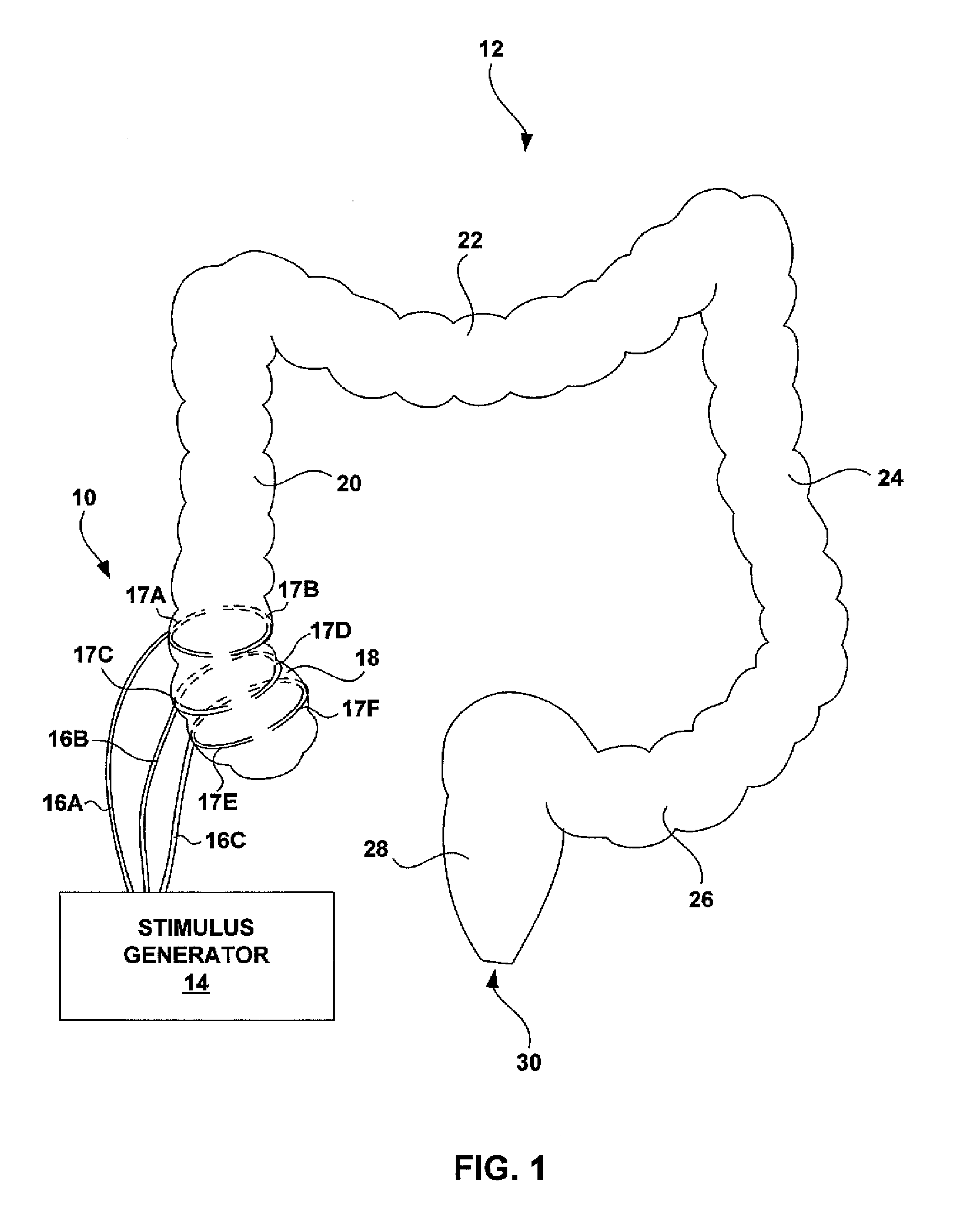 Electrical stimulation of the colon to treat chronic constipation