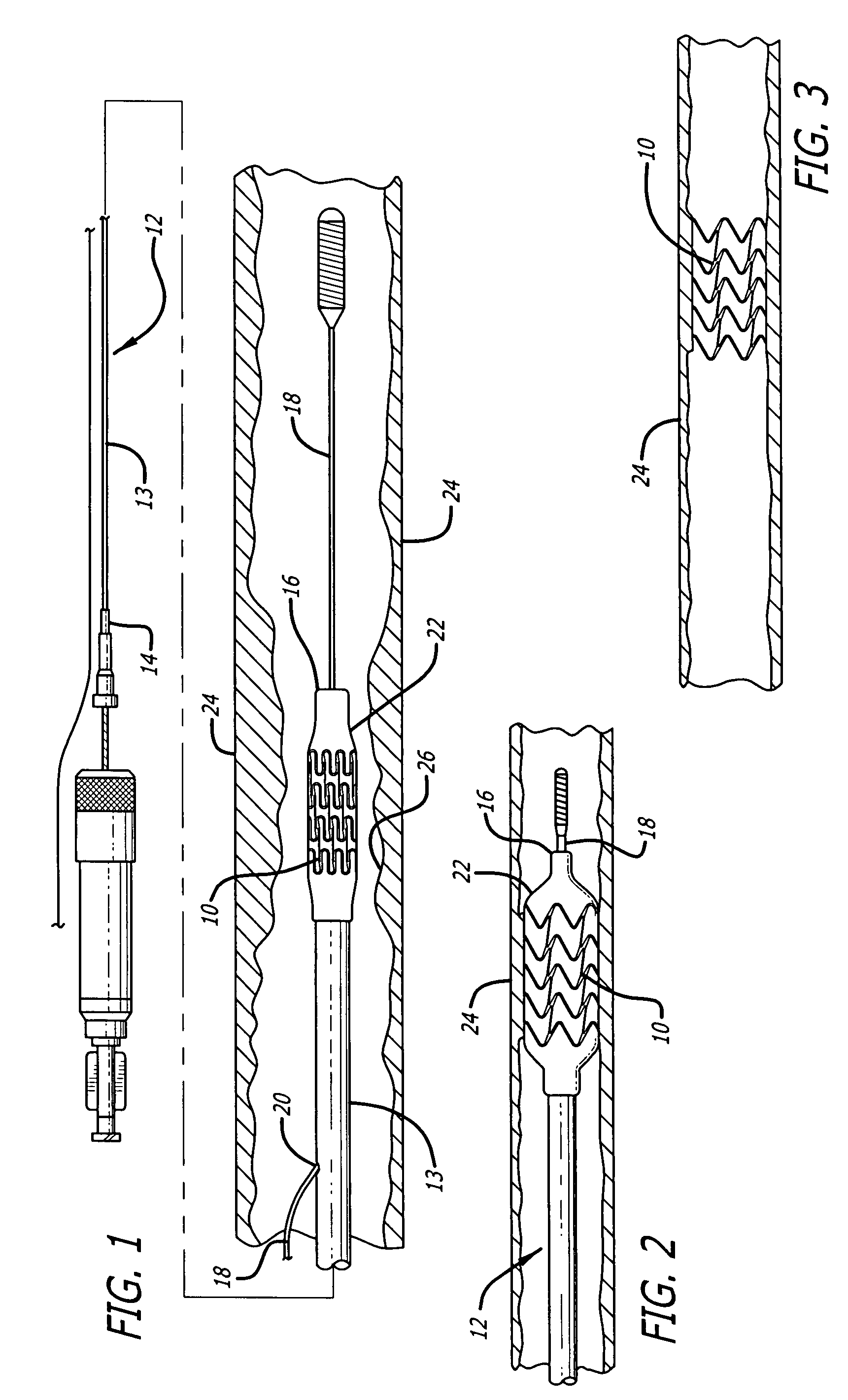 Intravascular stent with integrated link and ring strut