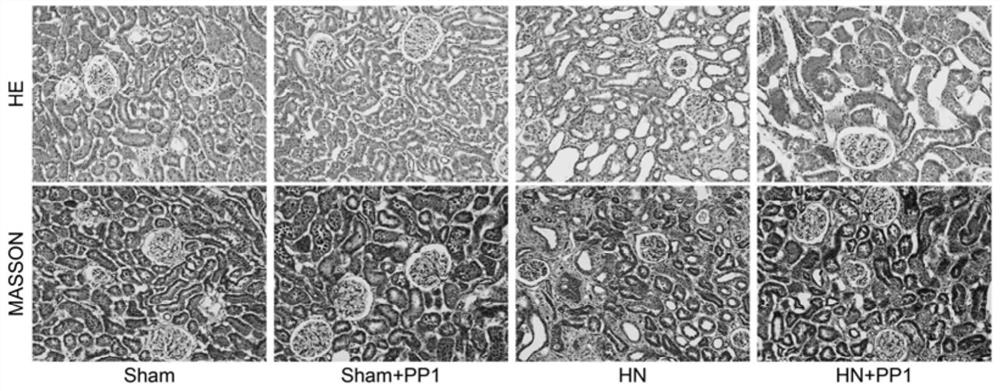 Application of Src inhibitor in preparation of medicine for preventing or treating uric acid nephropathy