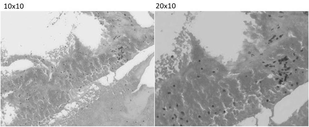 A method for preparing thyroid and breast fine-needle aspiration cell tissue block