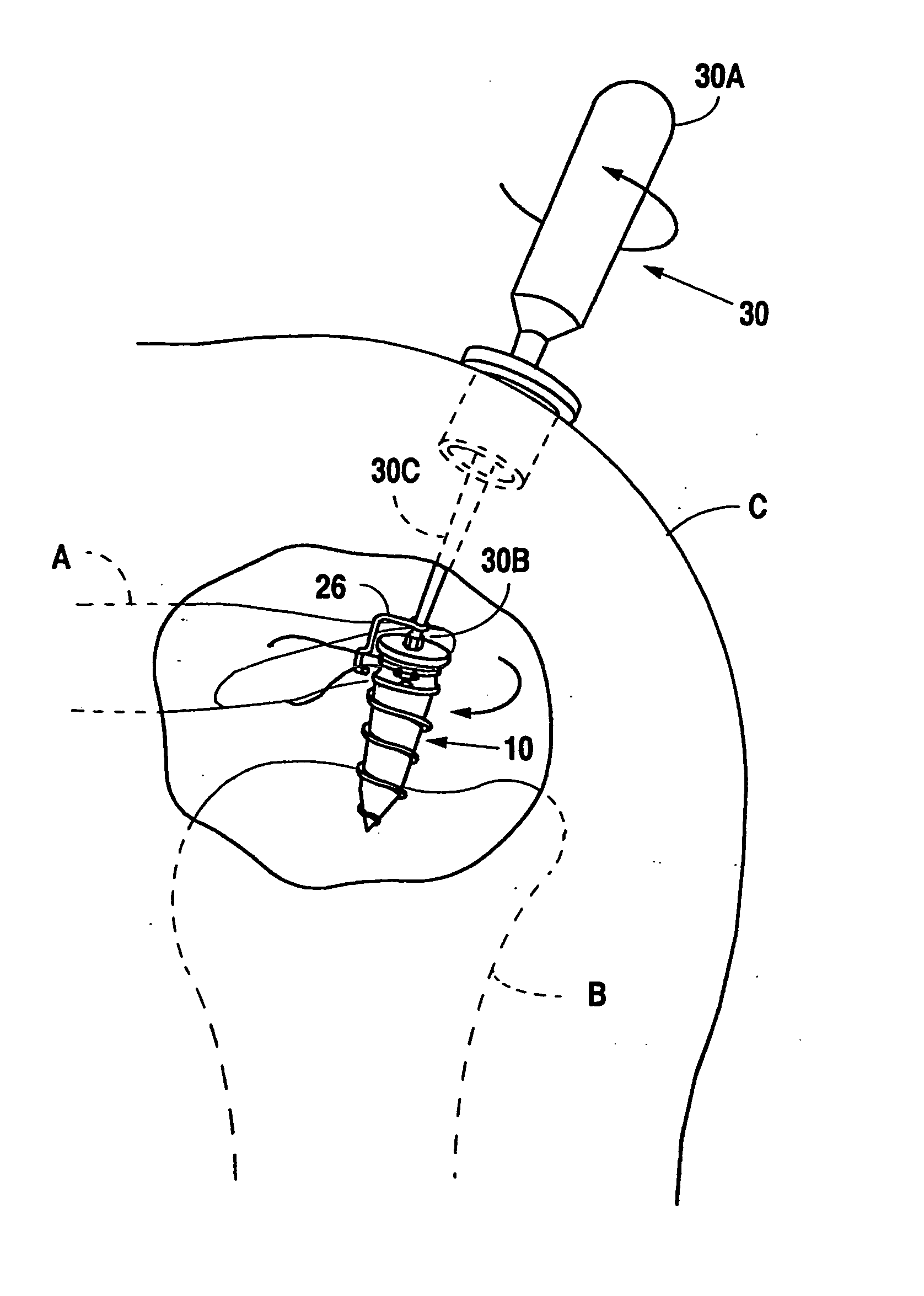 Suture anchor device, kit and method