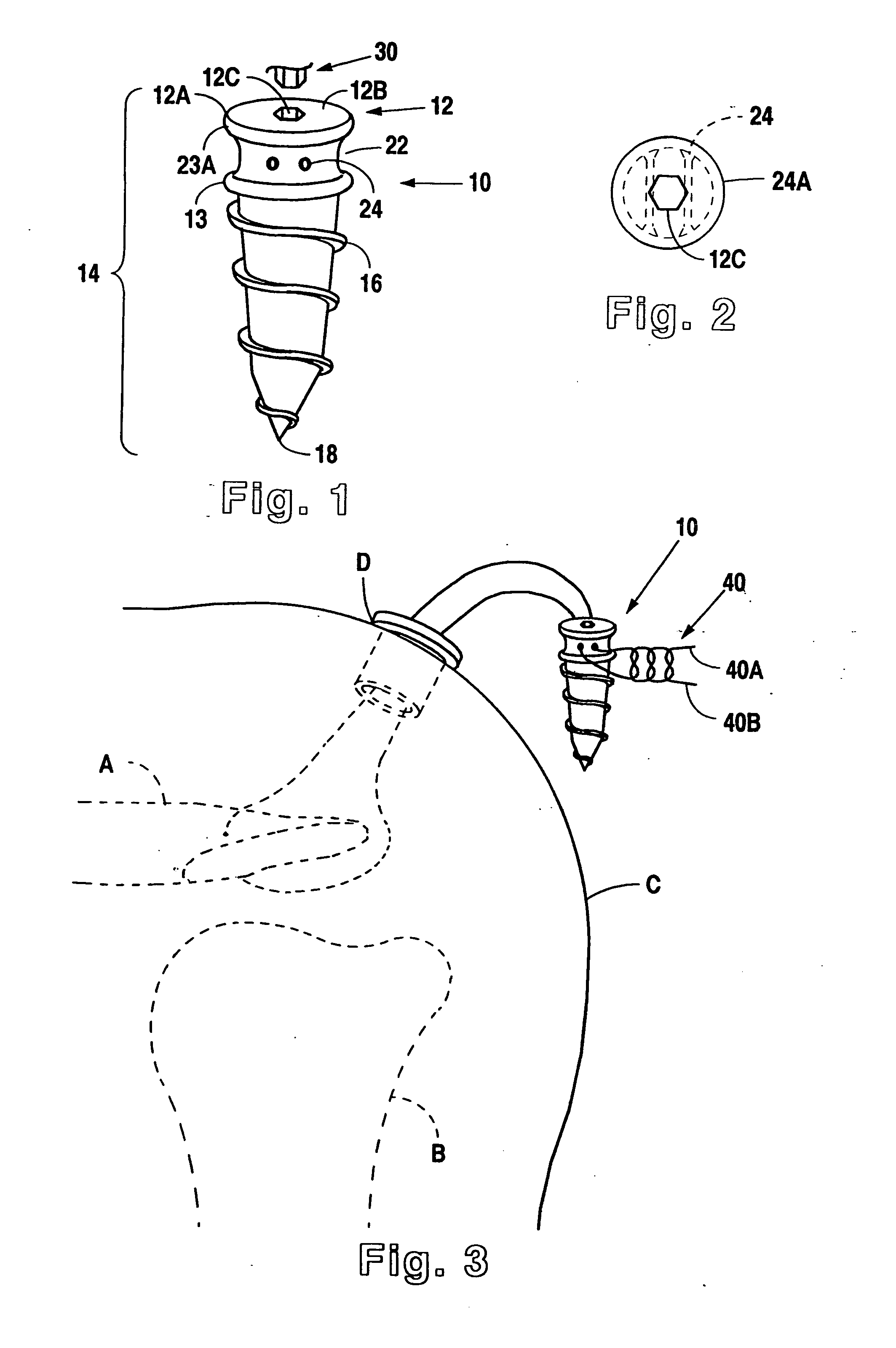 Suture anchor device, kit and method