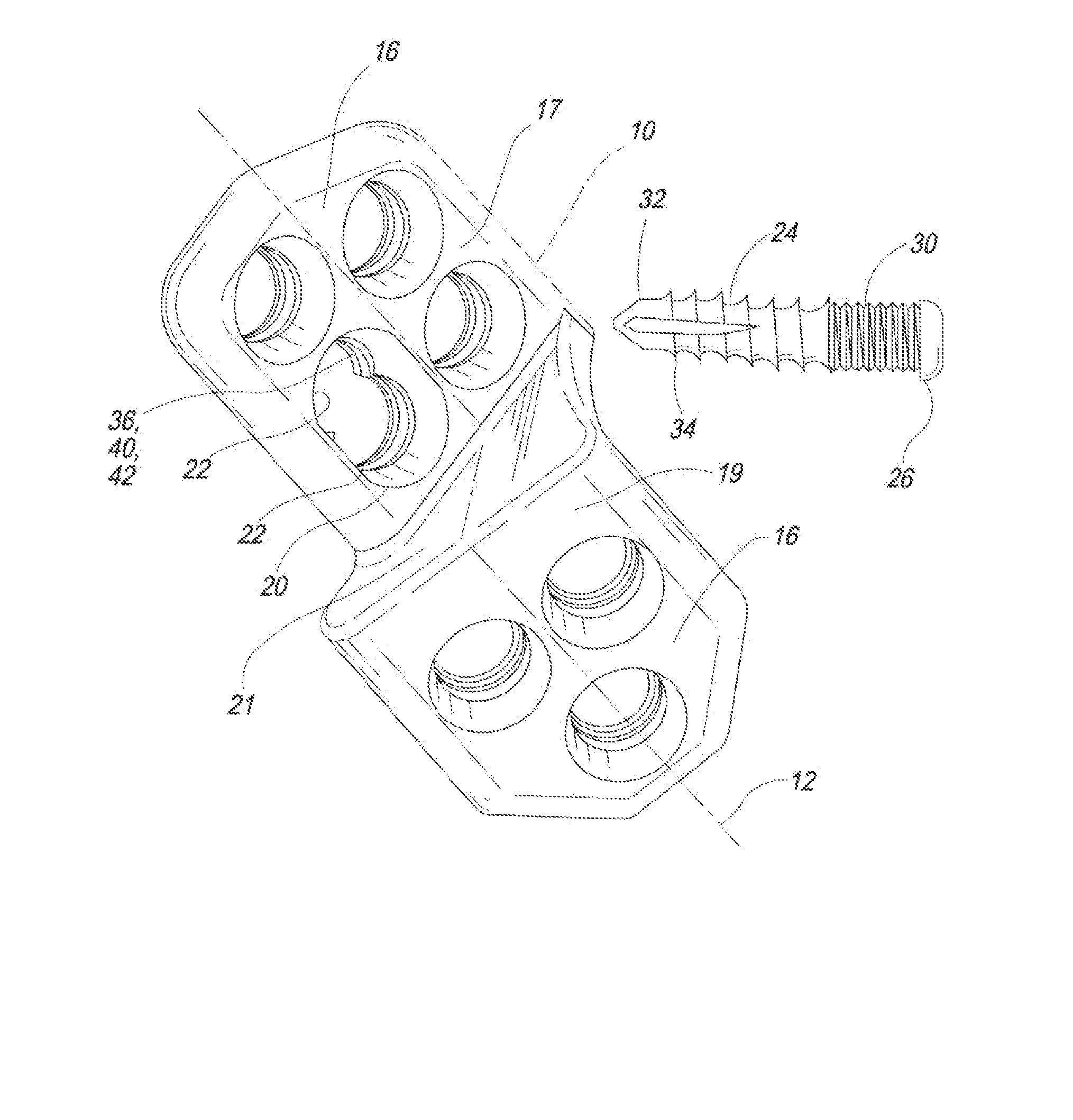 Locking tpo plate and method of use