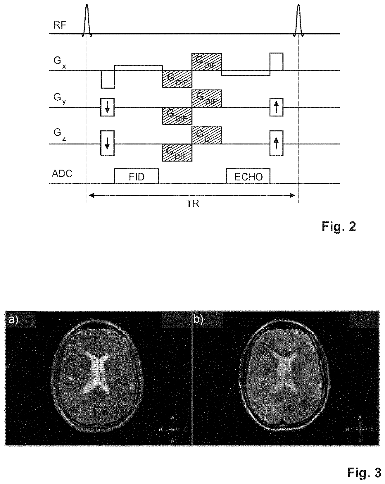 Dual echo steady state mr imaging using bipolar diffusion gradients