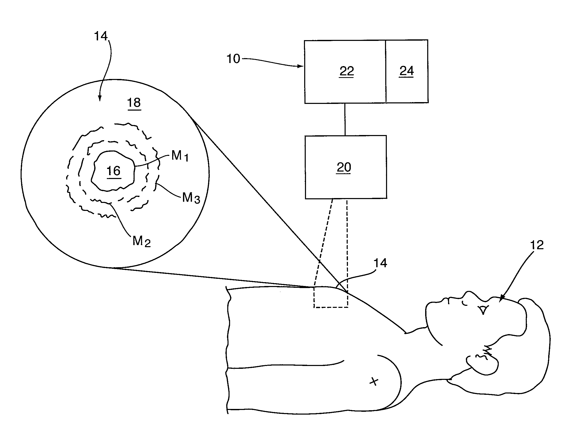 Method and apparatus for diagnosis of tumor activity using tumor interstitial fluid pressure