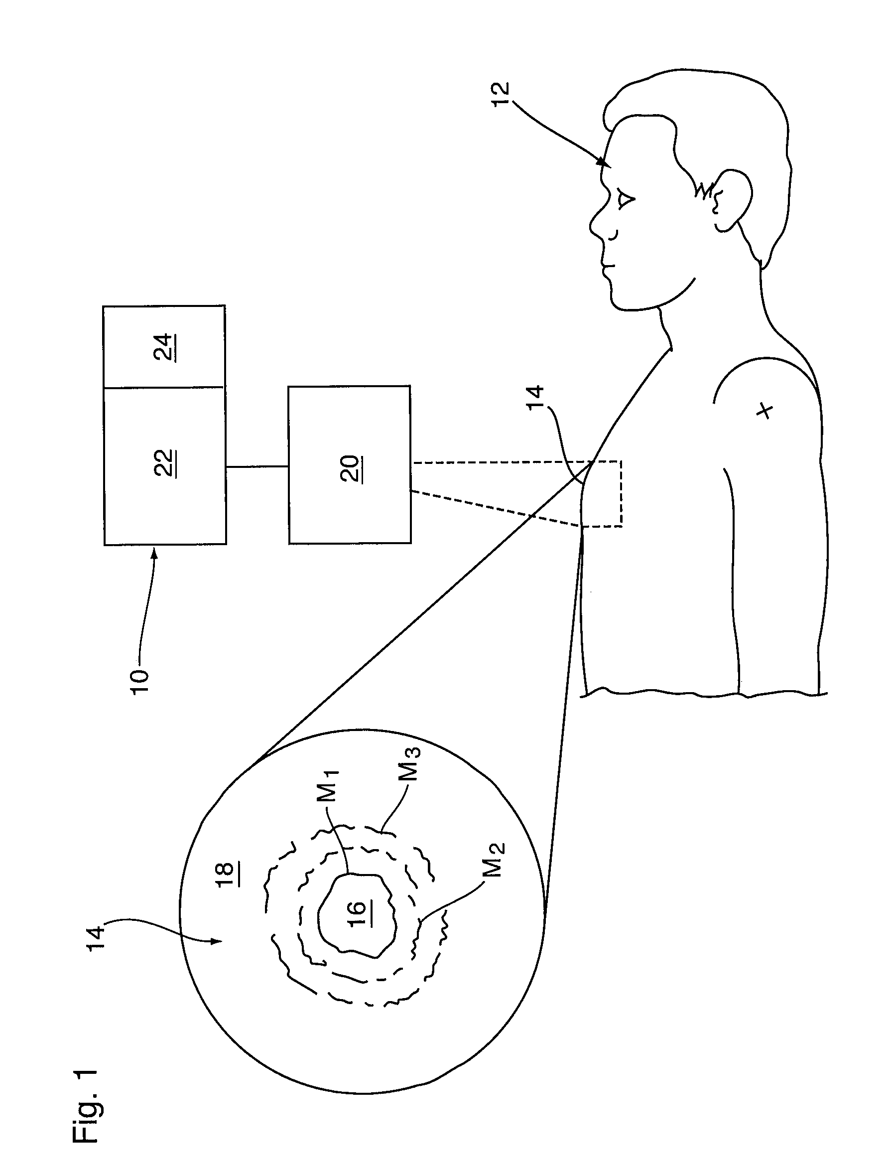 Method and apparatus for diagnosis of tumor activity using tumor interstitial fluid pressure