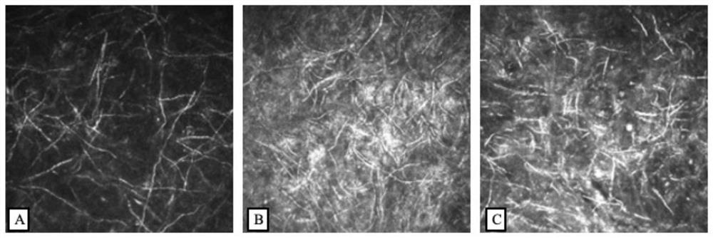 Infectious keratopathy living pathogen detection method combining deep learning and cornea living confocal microscopy