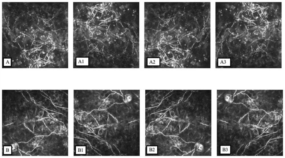 Infectious keratopathy living pathogen detection method combining deep learning and cornea living confocal microscopy