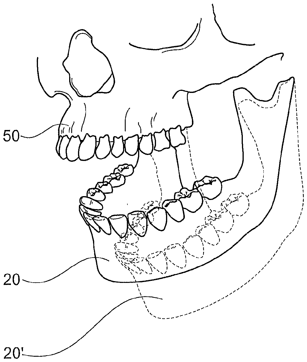 Method for detecting the movement of a temporomandibular joint