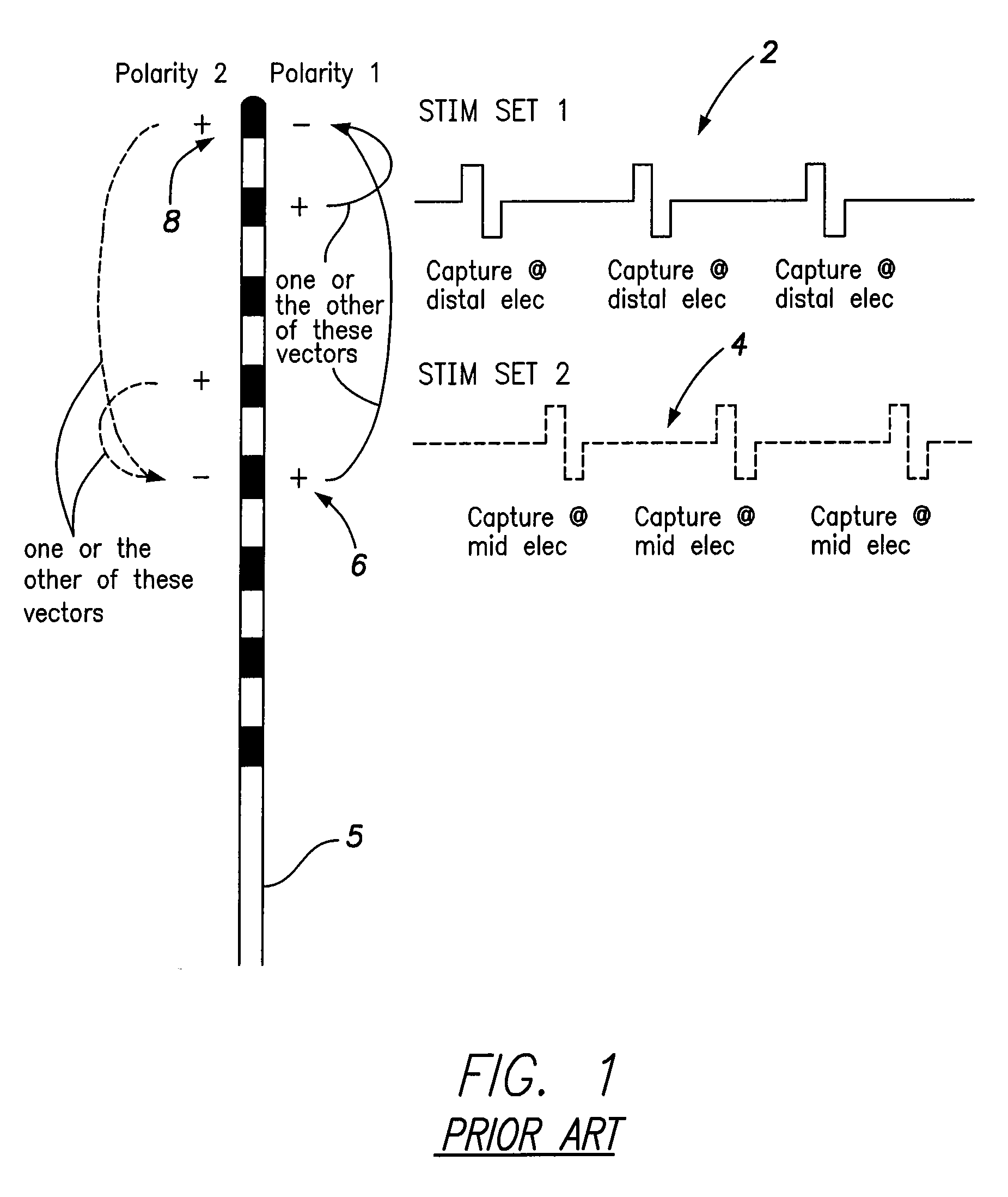 Systems and methods for providing a distributed virtual stimulation cathode for use with an implantable neurostimulation system