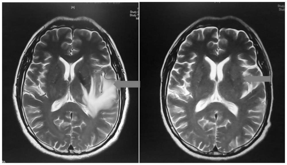 Applications of apatinib in preparation of drugs for preventing and treating radiation induced brain injury