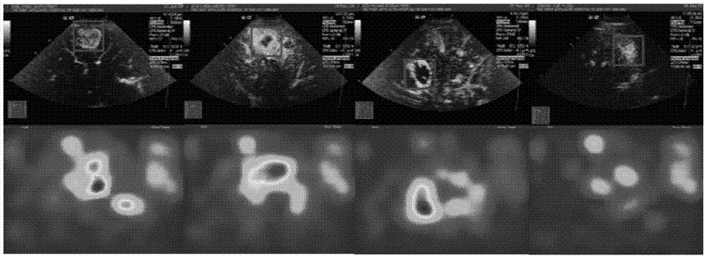 Method for automatically identifying liver tumor type in ultrasonic image