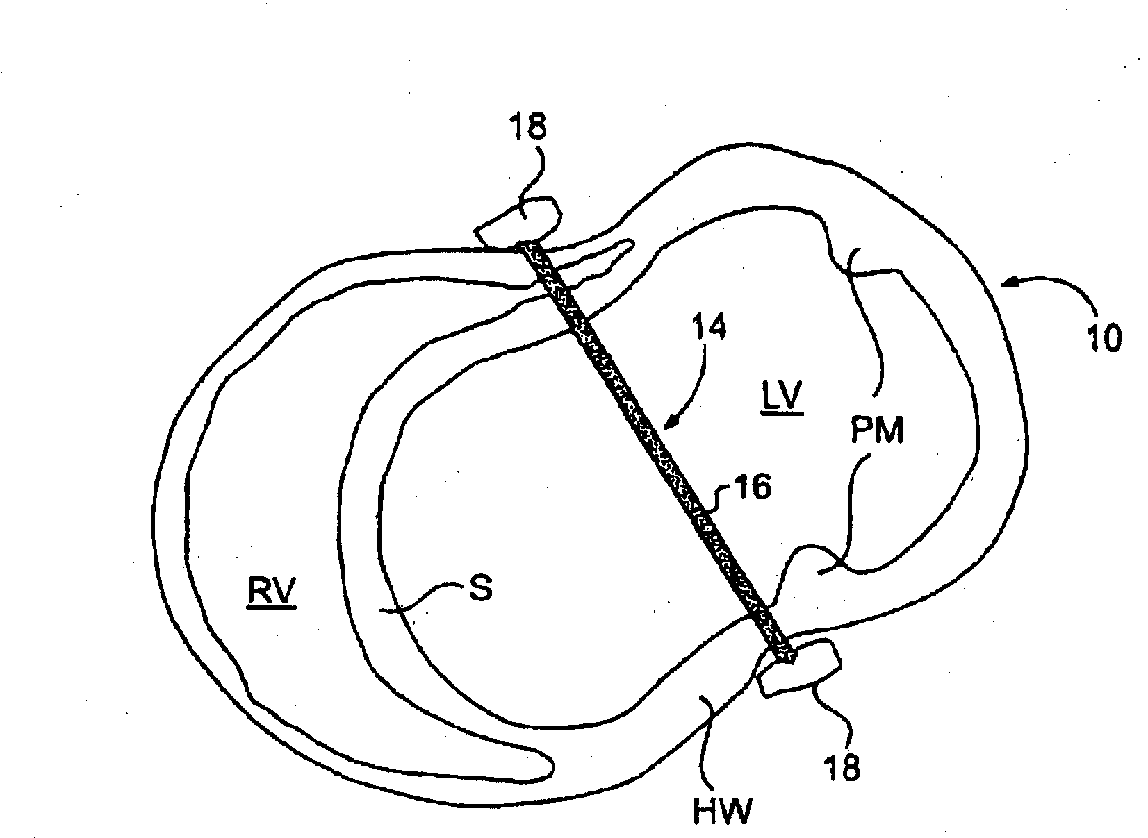 Methods and Devices for Improving Mitral Valve Function