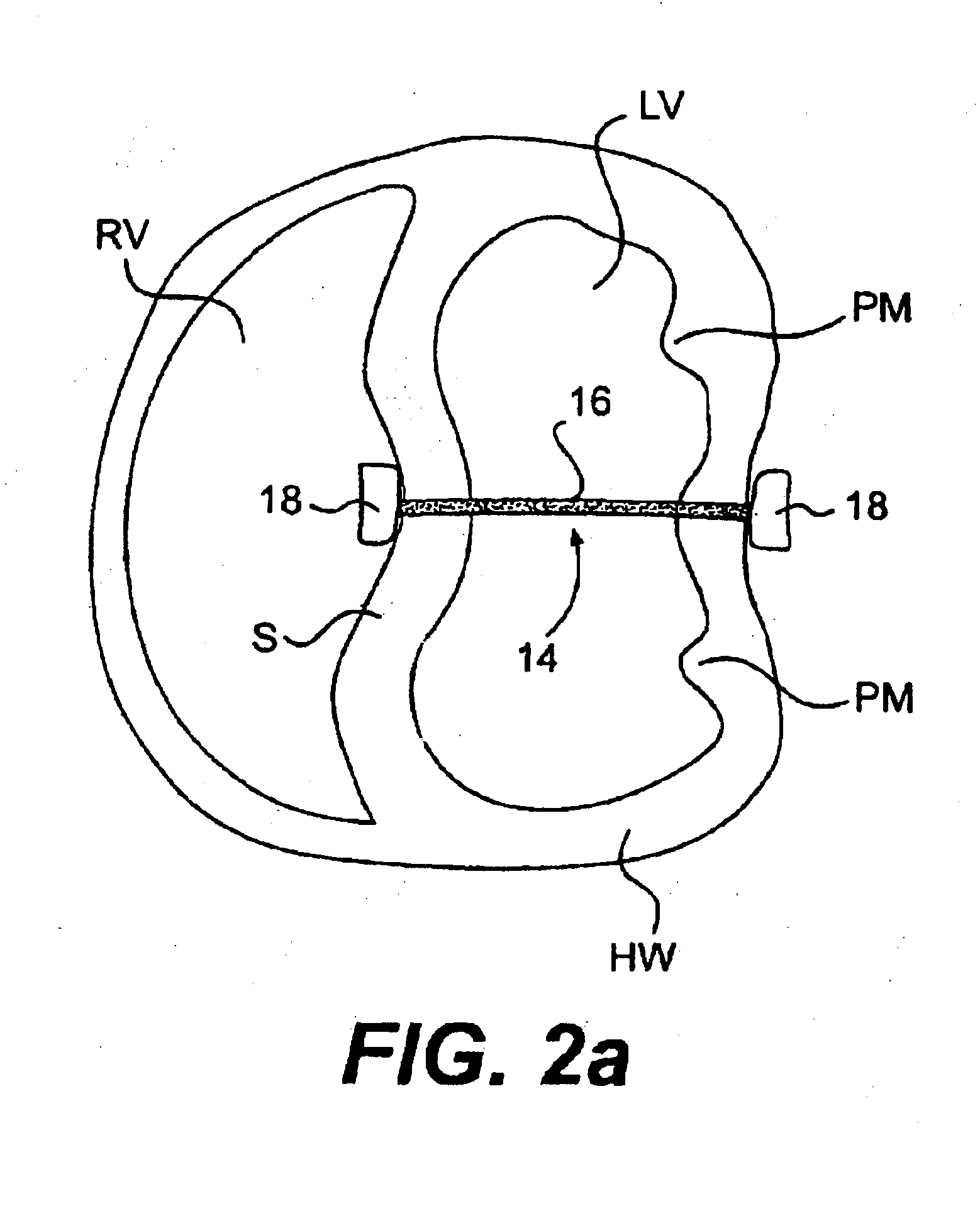 Methods and Devices for Improving Mitral Valve Function